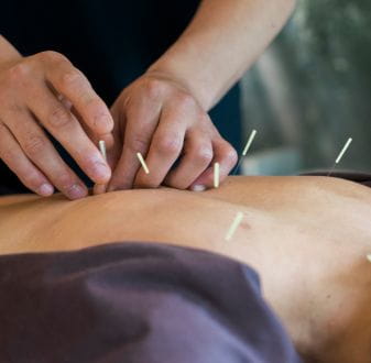 Acupuncturist working